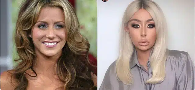 Celebrity Plastic Surgery Transformations