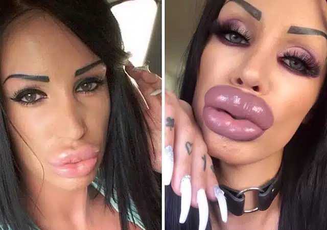 19 Disturbing Times People Took Plastic Surgery Too Far