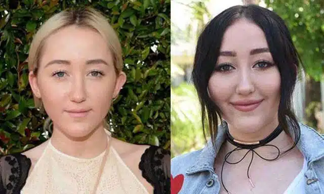 Celebrity Plastic Surgery Transformations