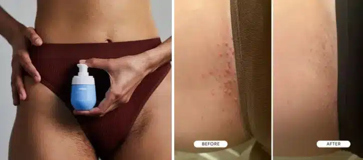 Ingrown hair oil