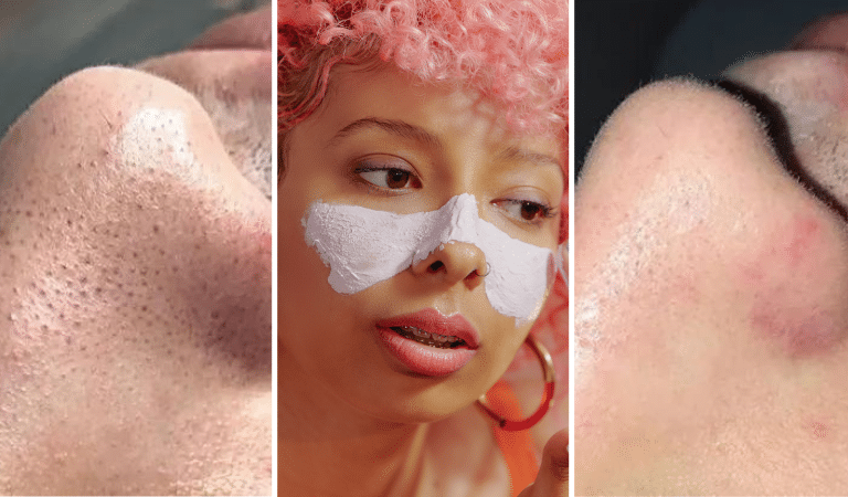 How to Get Rid of Blackheads: Clear Skin, Here We Come