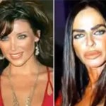 Celebrity Plastic Surgery Transformations