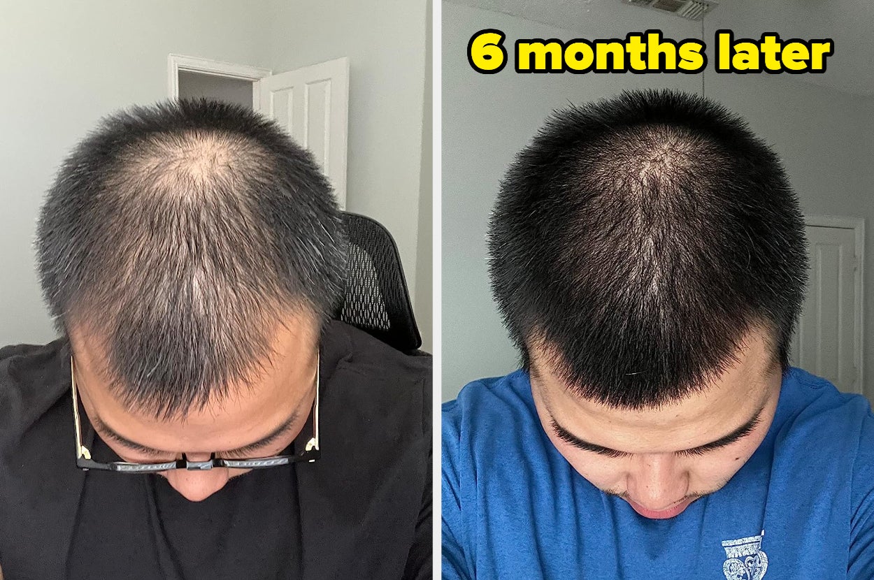 reviewer's before and after of hair that looks noticeably fuller and thicker after 6 months of using the biotin shampoo